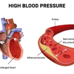 Understanding High Blood Pressure: A Global Crisis