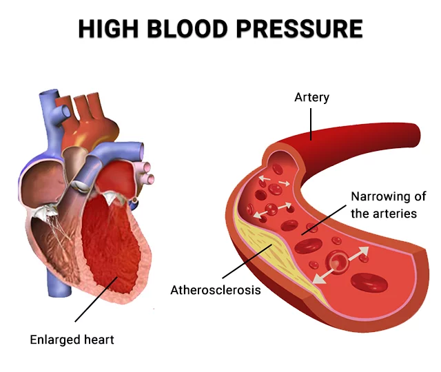 Understanding High Blood Pressure: A Global Crisis